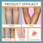 Turmeric Varicose Vein Relief Spray (50ml) - Relief from Varicose Veins – Naturally |Buy 1 Get 1 FREE | Limited Stock Available