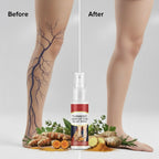 Turmeric Varicose Vein Relief Spray (50ml) - Relief from Varicose Veins – Naturally |Buy 1 Get 1 FREE | Limited Stock Available